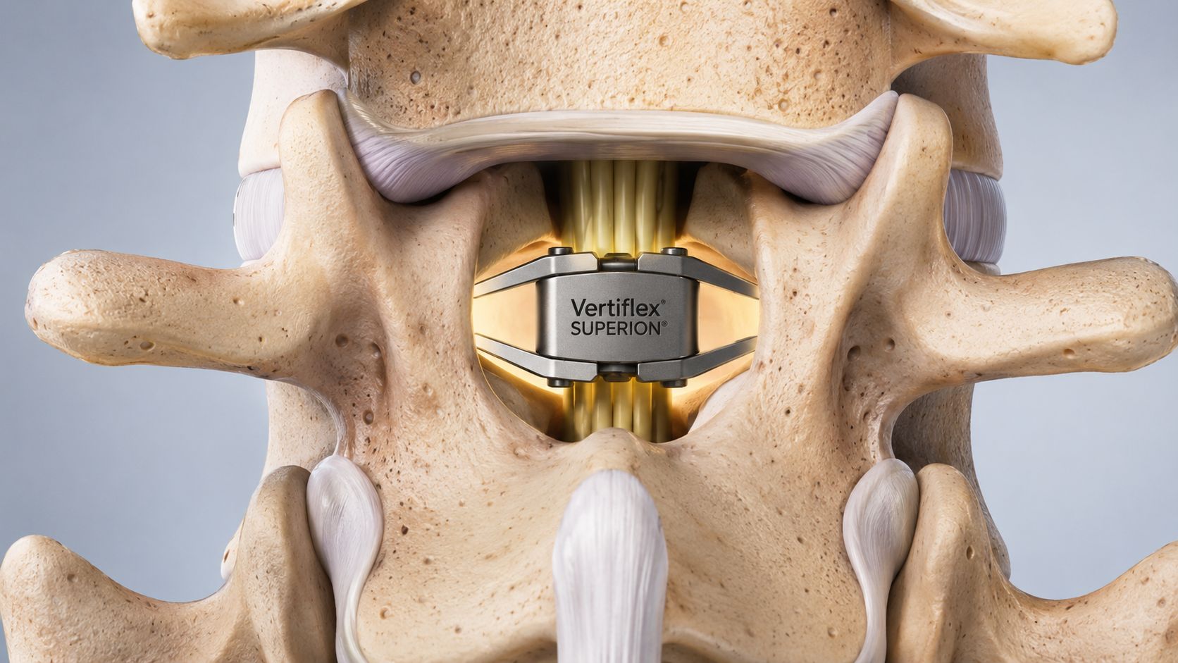 A 3D medical illustration showing the Vertiflex Superion implant inserted between two vertebrae in the human spine.
