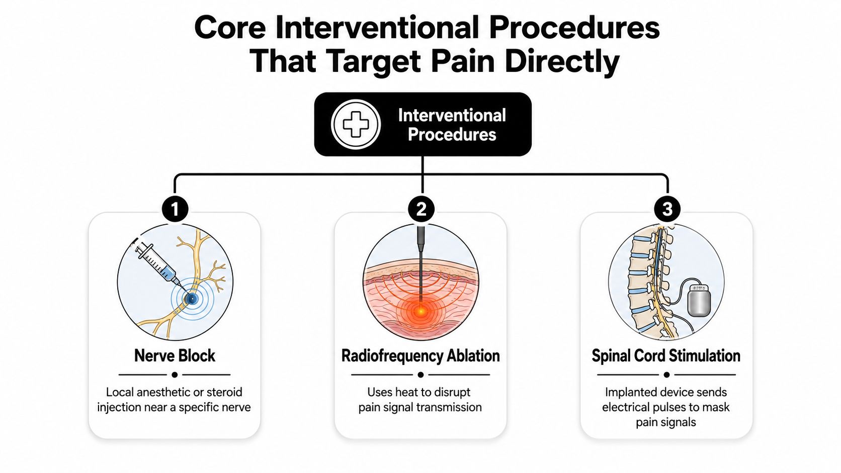 advanced pain management interventional procedures 20.9% of U.S. adults, about 51.6 million people, lived with chronic pain in 2021, and 6.9%, about 17.1 million people, had high-impact chronic pain that restricted daily activities, according to the CDC report on chronic pain prevalence. That scale is why advanced pain management is not a niche service. It's a practical response for people whose pain has outgrown simple medication changes and who need a plan built around function, not just symptom suppression. Advanced Pain Management: Opioid-Free Relief Guide A medical infographic showing three core interventional pain procedures: nerve block, radiofrequency ablation, and spinal cord stimulation.