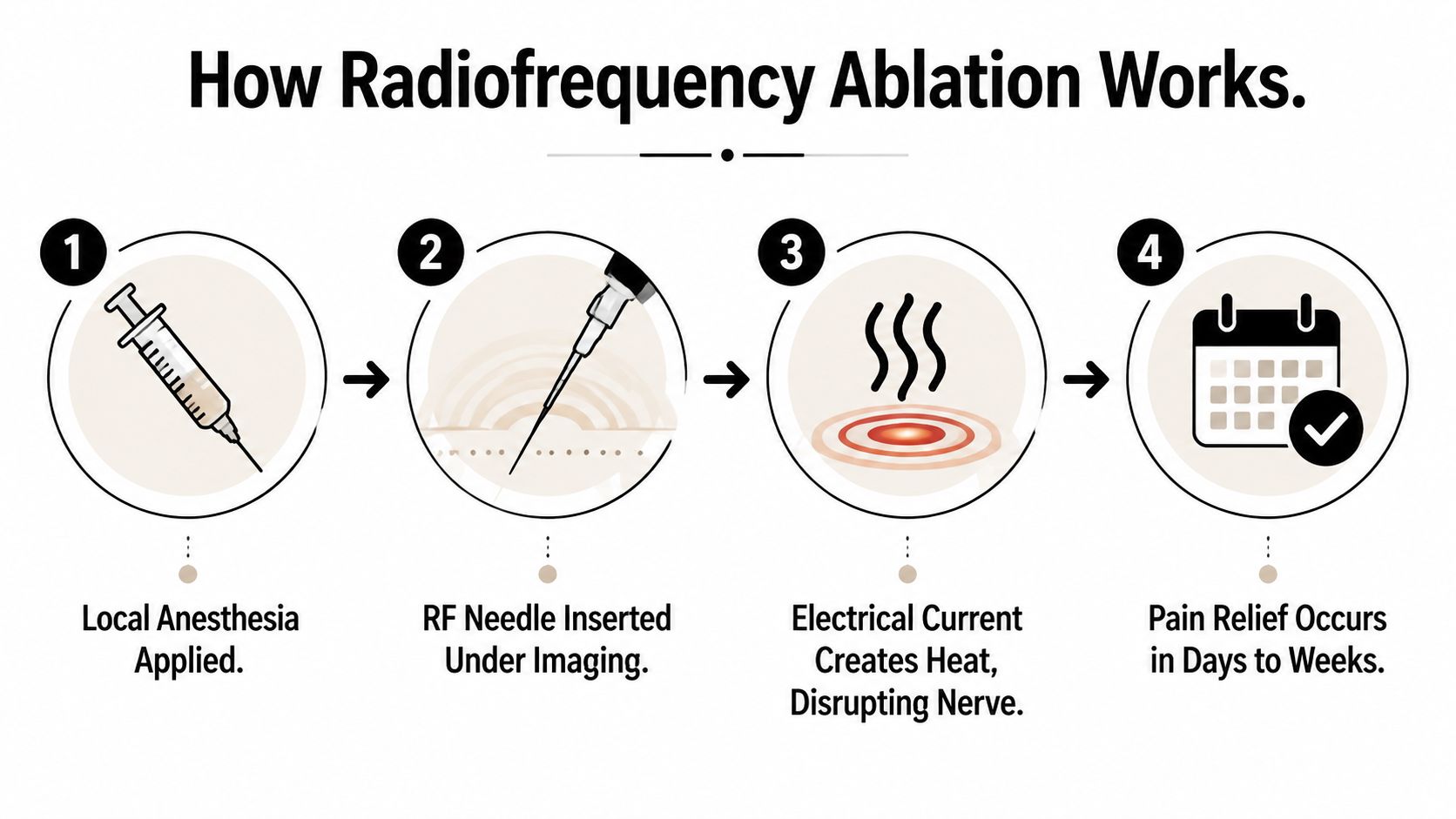 radiofrequency ablation vs rhizotomy ablation process Radiofrequency ablation and rhizotomy are often the same procedure, with early radiofrequency studies reporting success rates ranging from 27% to 90% depending on surgical history and patient group. The distinction is usually between standard thermal RFA and advanced approaches such as endoscopic rhizotomy. Radiofrequency Ablation vs Rhizotomy: A Clear Patient Guide A four-step infographic illustrating the medical procedure of radiofrequency ablation used for pain management treatment.