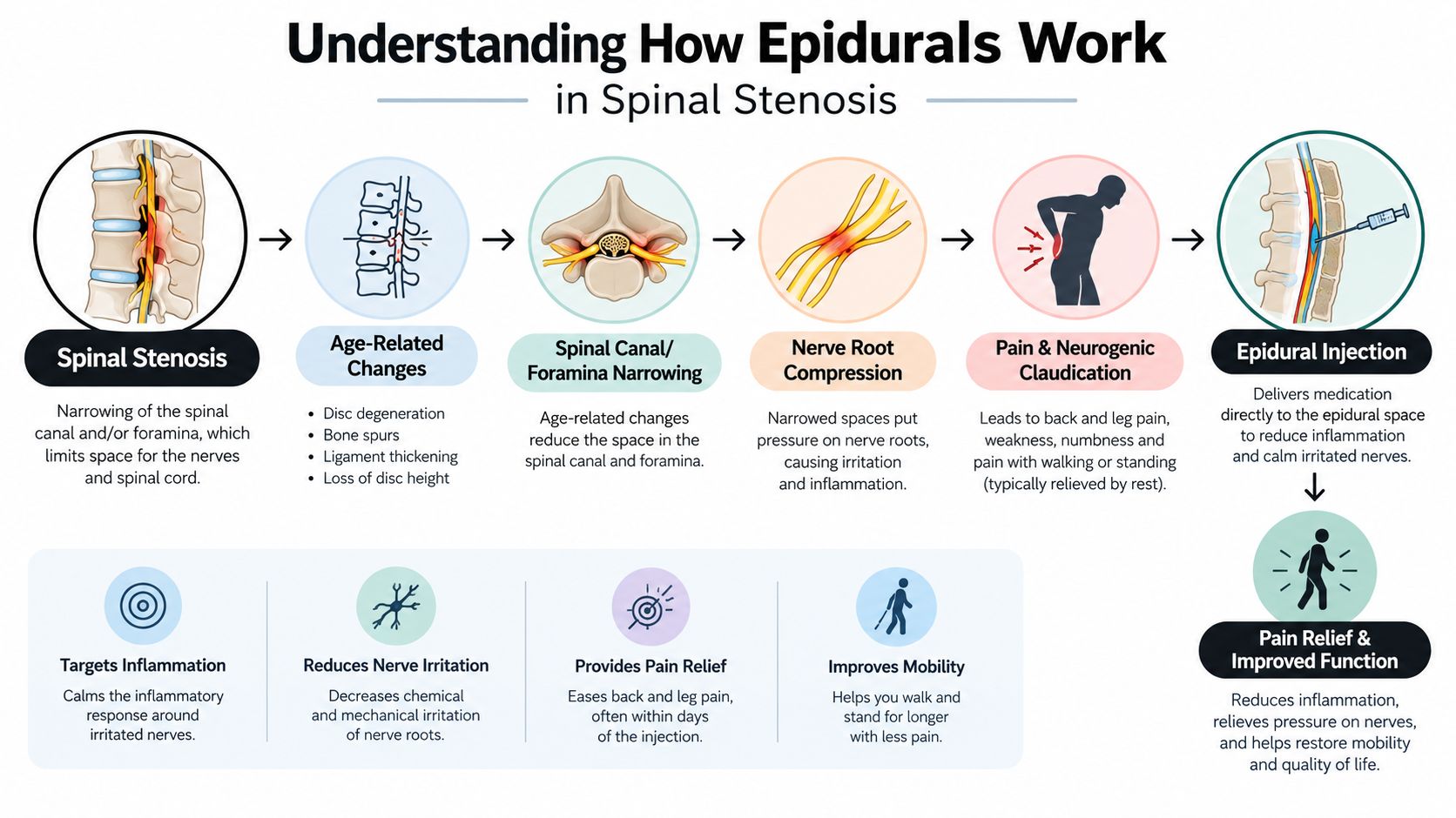 A diagram explaining how epidural injections treat spinal stenosis by reducing nerve inflammation and improving patient mobility.