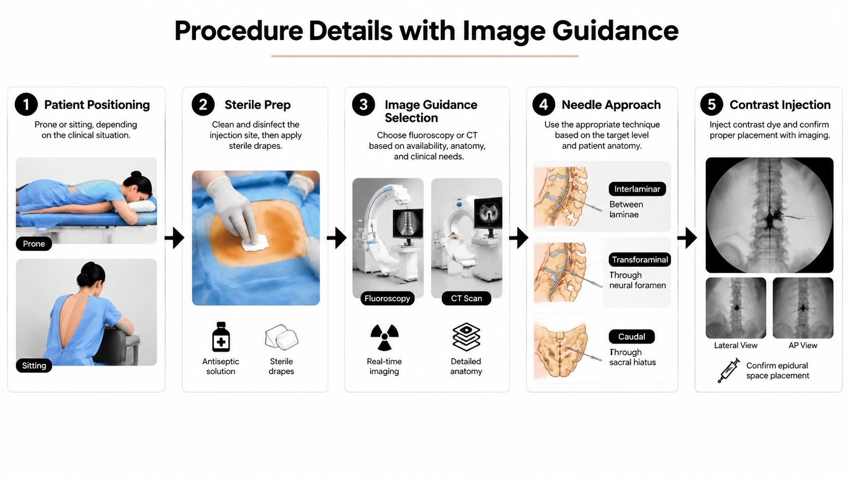 A procedural flowchart illustrating the five clinical steps for performing a spinal stenosis epidural injection with imaging.