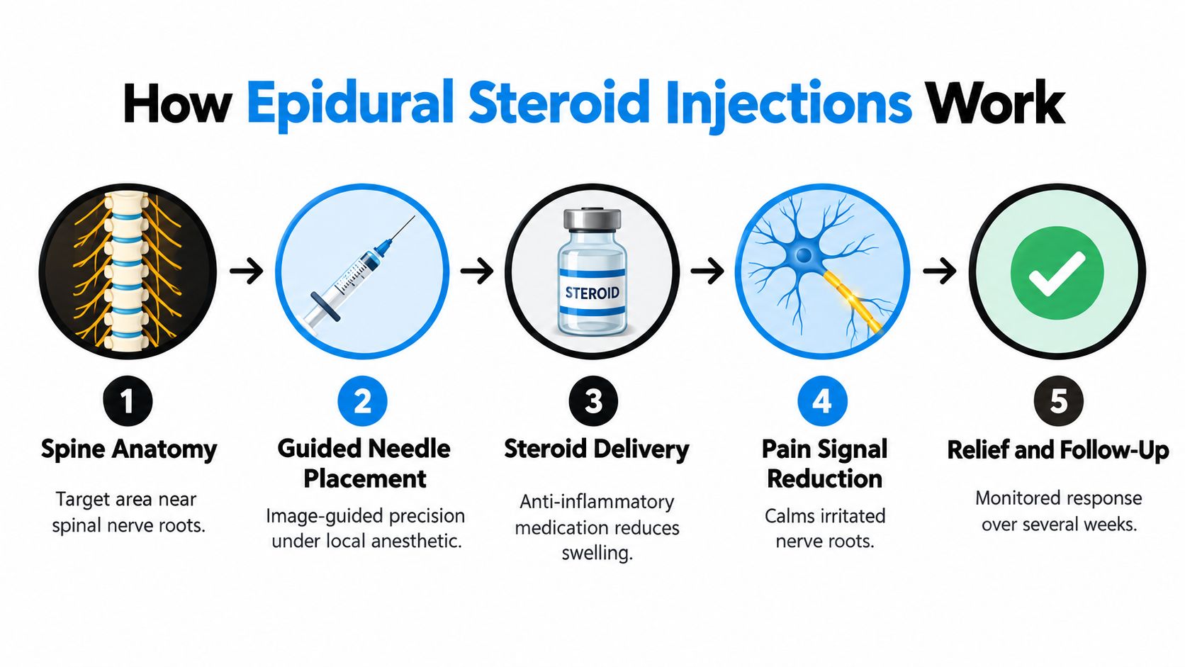A diagram illustrating the five-step process of how epidural steroid injections are used for spine pain relief.