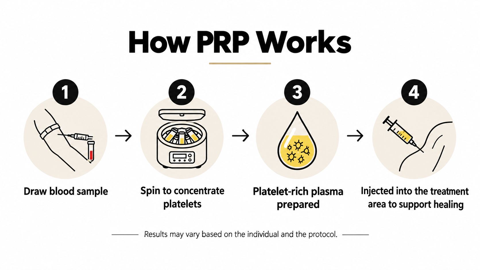 A four-step infographic illustrating the medical procedure for preparing and injecting platelet-rich plasma therapy.
