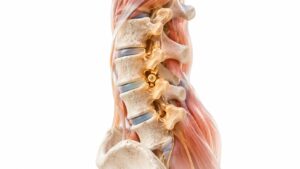what is facet joint syndrome lumbar spine Learn about how our practice can help you with your pain & wellness needs Blog what is facet joint syndrome lumbar spine Learn about how our practice can help you with your pain & wellness needs Blog