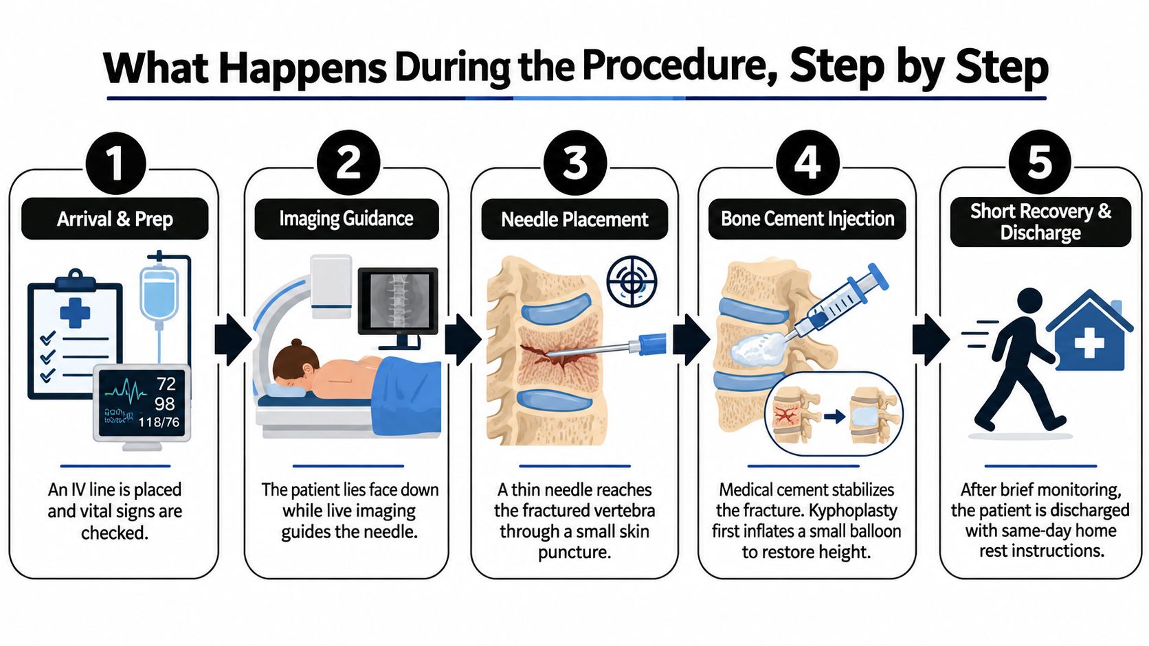 what is vertebroplasty and kyphoplasty procedure steps Vertebroplasty injects bone cement into a fractured vertebra to stabilize it and relieve pain, while kyphoplasty adds a balloon step before cement placement to potentially restore vertebral height and reduce leakage. In pooled case-series data, cement extravasation occurred in approximately 41% of vertebroplasty cases compared with 9% of kyphoplasty cases. What Is Vertebroplasty and Kyphoplasty: A Patient's Guide A five-step infographic illustrating the kyphoplasty and vertebroplasty procedure process for treating spinal fractures.